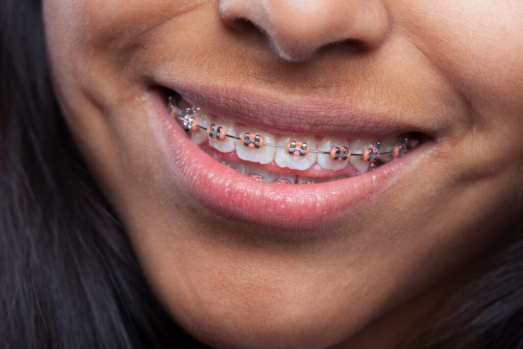 brackets