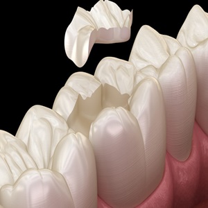 Curaciones Dentales