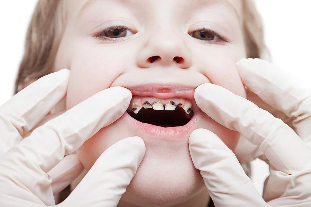 caries en niños