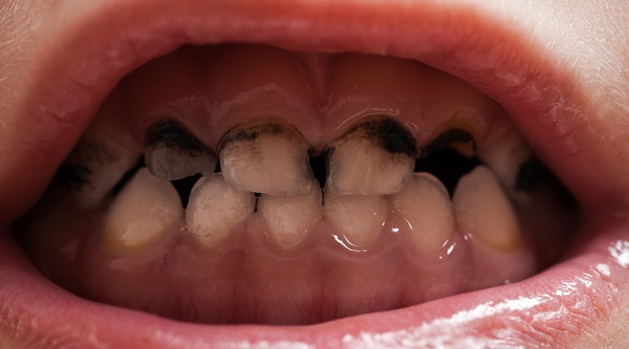 caries en niños