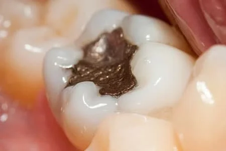 curaciones dentales