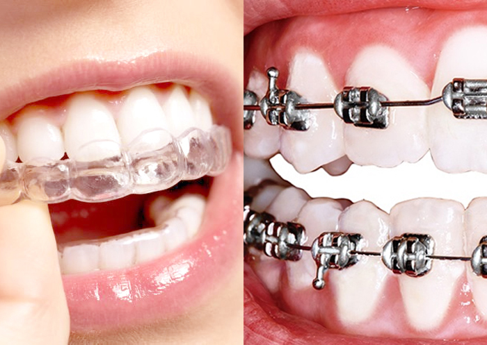 La ortodoncia brackets
