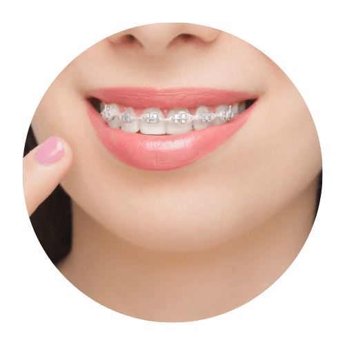 brackets