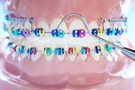 ortodoncia brackets 