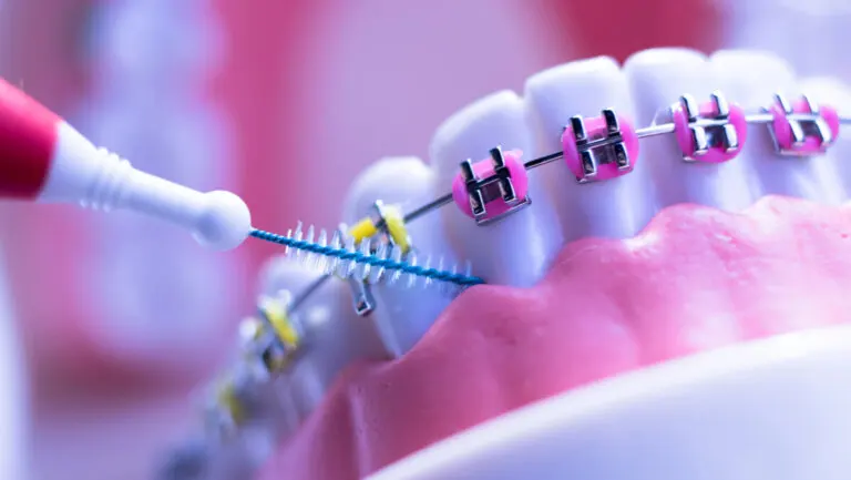 ortodoncia brackets