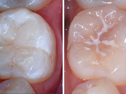 Sellantes Dentales