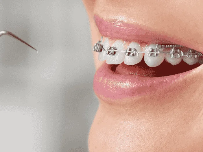 brackets
