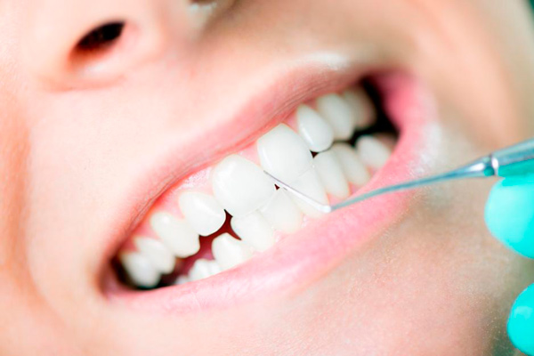 Profilaxis dental